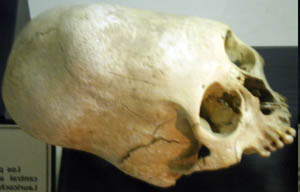Измененный череп