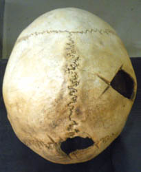 Трепанированный череп